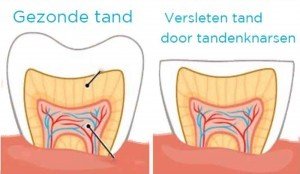 Bruxisme Tandartsen Klaverblad